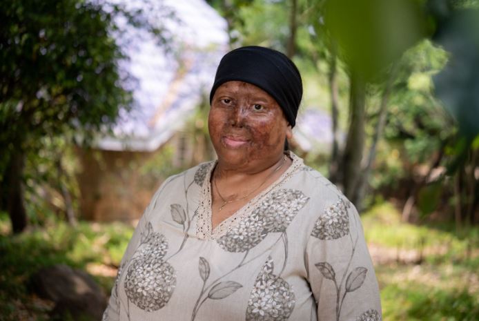 "Empowering Acid Attack Survivors: The Fight for Dignity and Economic Equity"